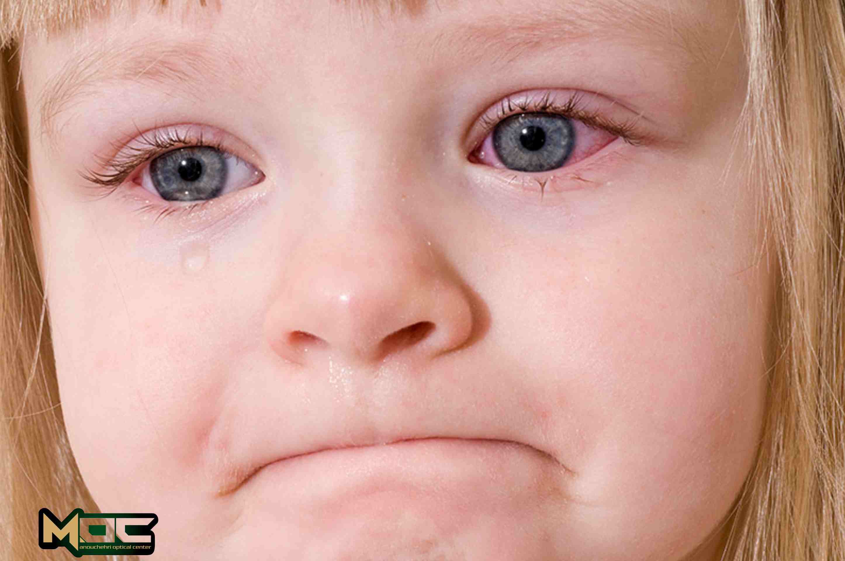  چگونه حساسیت و آلرژی چشم ایجاد می شود