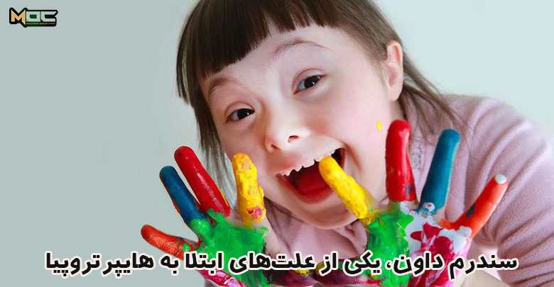 سندرم داون و هایپرتروپیا