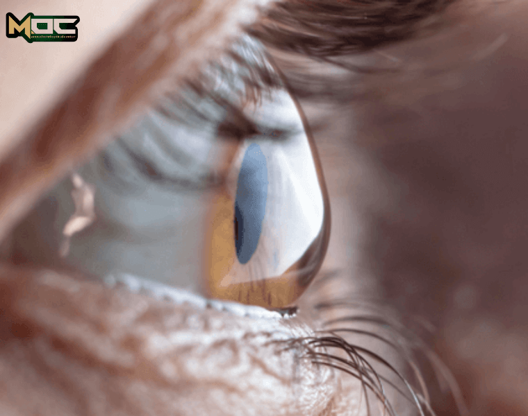 علل قوز قرنیه