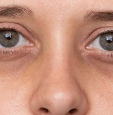 پنج دلیل مهم تیرگی دور چشم