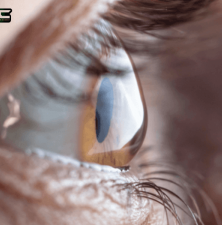 زندگی با قوز قرنیه چگونه خواهد بود؟